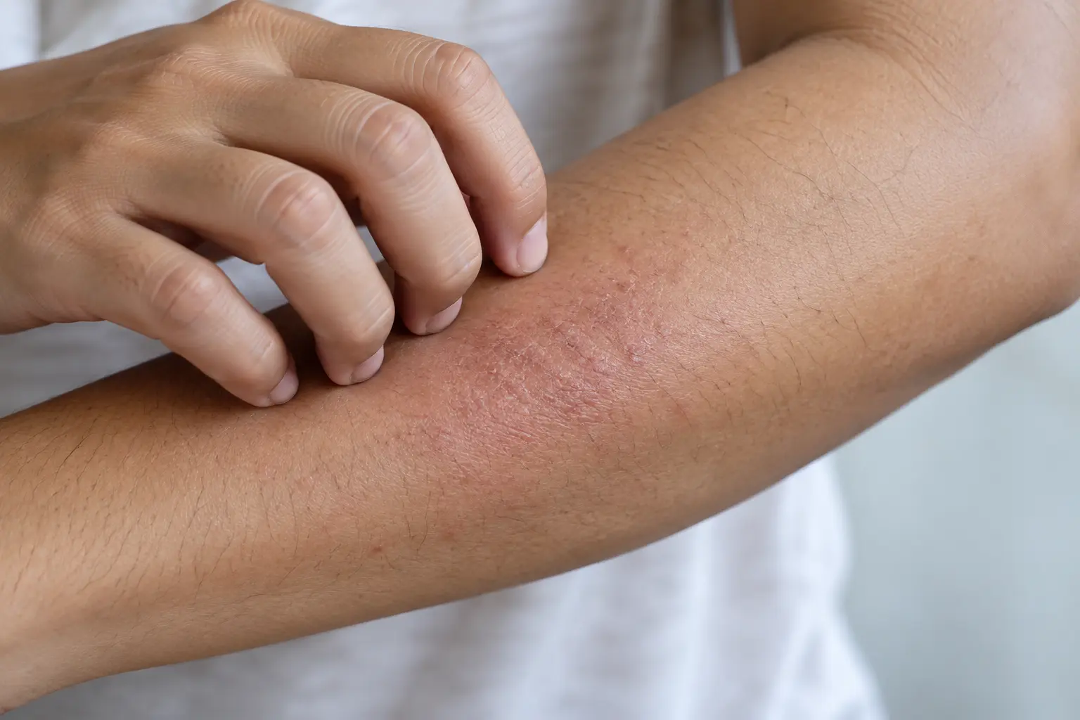 Close-up kulit lengan kering dan kemerahan akibat garukan