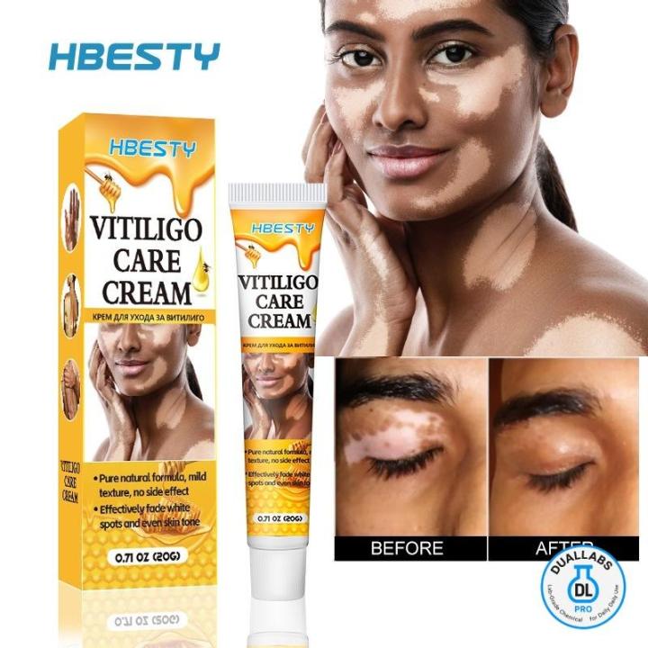 HBESTY Vitiligo Care Cream 20 Gram